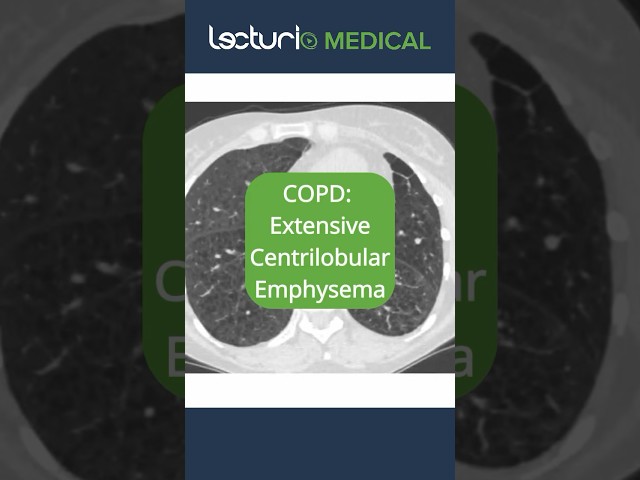 🔍 CT Scans Unveiled: Centrilobular Emphysema! #Emphysema #Radiology #usmle #copd