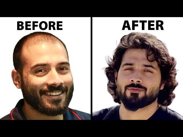 My Remarkable Hair Transplant Journey | Hair Surgeon Reacts