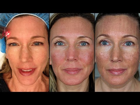My Fraxel Dual Laser Experience For Age Spots & Wrinkles