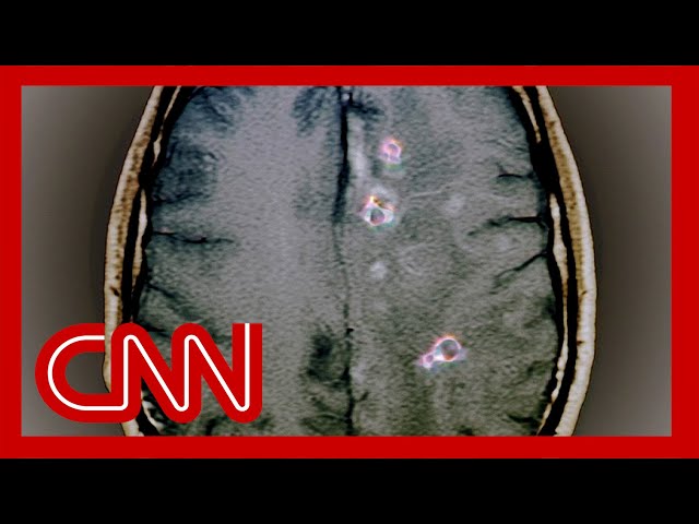 Dr. Gupta explains what could have led to RFK Jr. having a worm in his brain