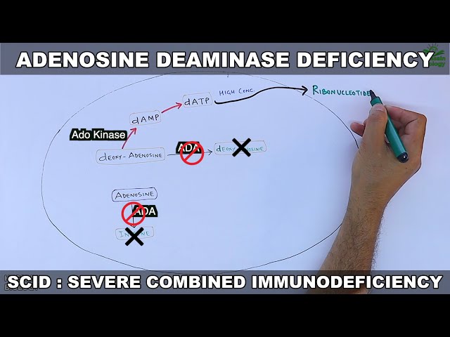 Adenosine Deaminase Deficiency | SCID