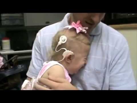 Cochlear Implants: People hearing for the first time!
