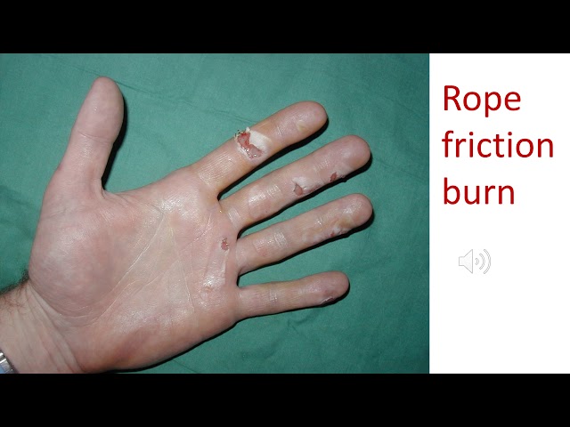 Burns 1, Clinical examples