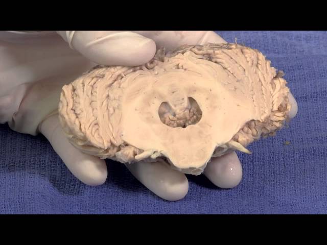 The Cerebellum: Neuroanatomy Video Lab - Brain Dissections