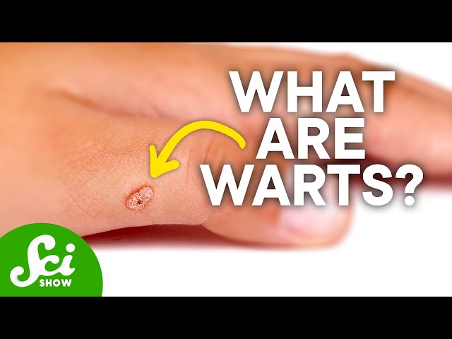 Do Toads Actually Give You Warts? | The Truth About Warts & How to Get Rid of Them