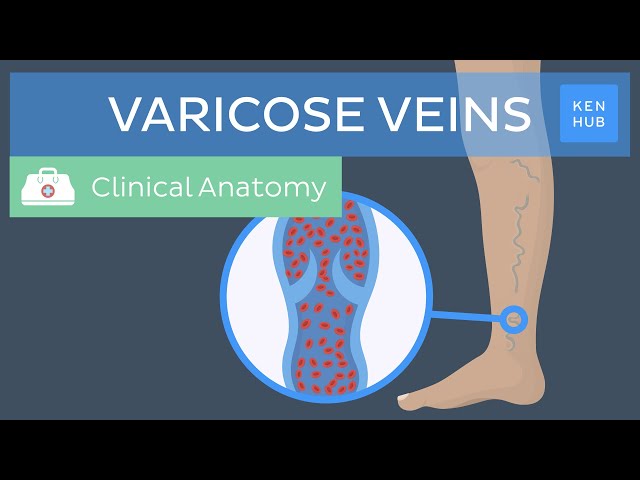 Varicose veins: Definition, causes, symptoms and treatment | Kenhub