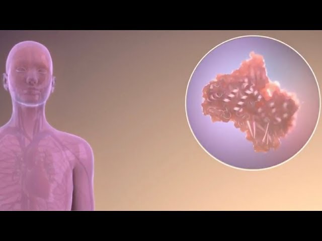 An Inside Look at Fabry Disease