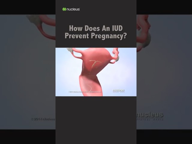 How Does An IUD Prevent Pregnancy? #shorts