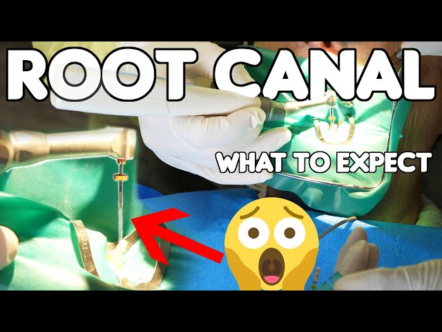 What's Really Happening During A Root Canal Procedure