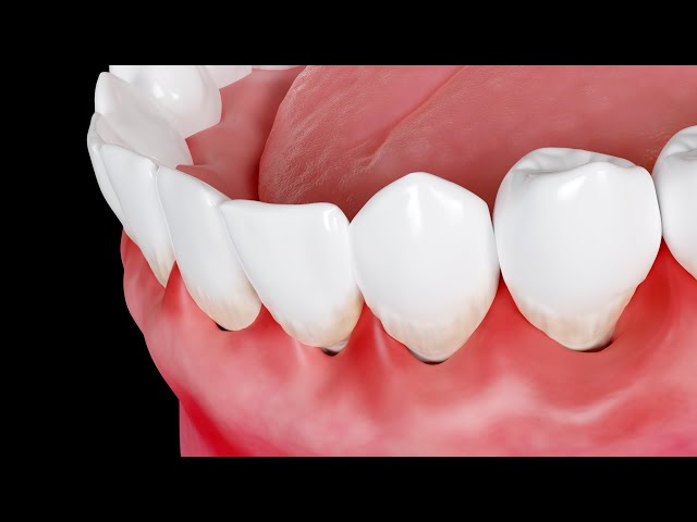 Why are my gums swollen?