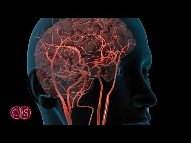 Symptoms of Stroke and Migraine | Cedars-Sinai