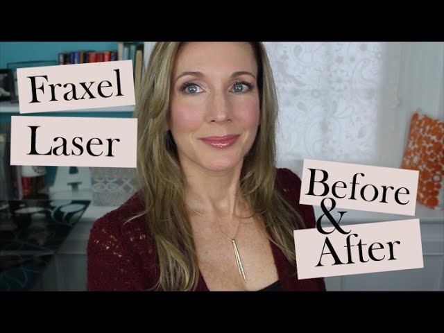 My 1st Fraxel Dual Laser Treatment | Before & After