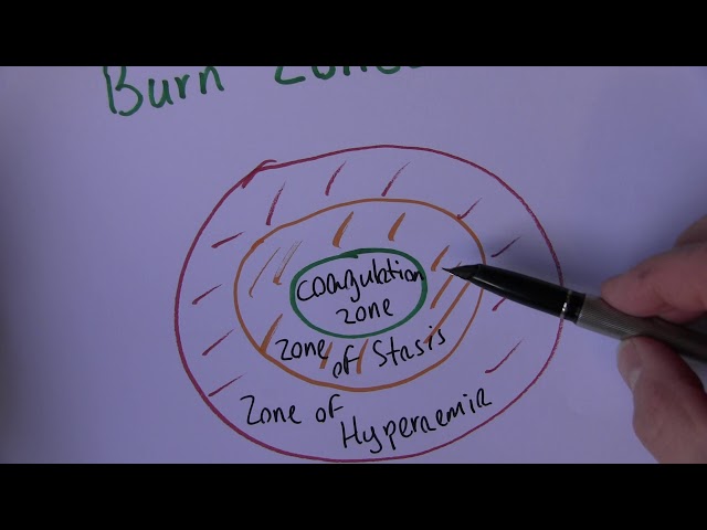 Burns 11, Zones of a burn