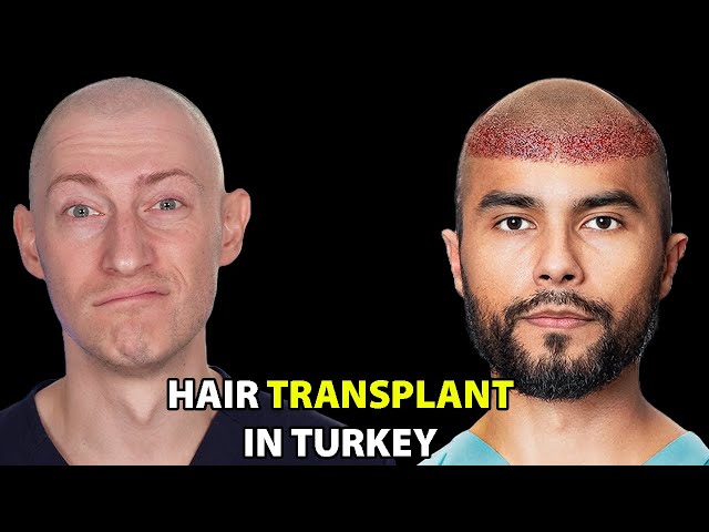I Went To Turkey For A Hair Transplant | Hair Surgeon Reacts