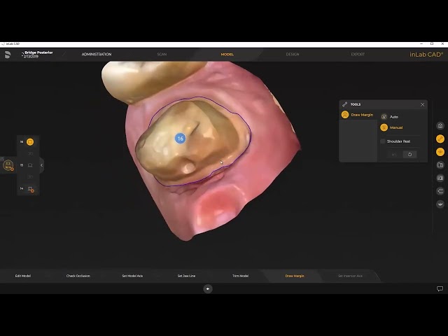 Primemill with inLab Software chairside workflow: creating a posterior bridge