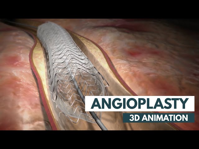 Angioplasty | 3D Animation + Real Footage