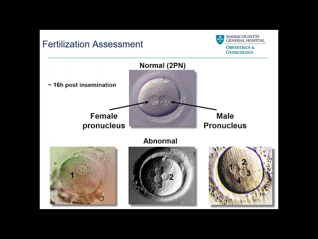 AI in IVF: Advances in infertility