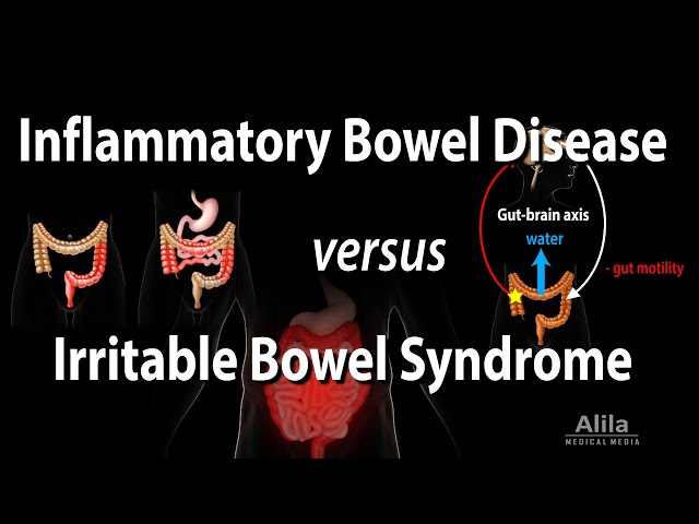 Inflammatory Bowel Disease vs Irritable Bowel Syndrome, Animation