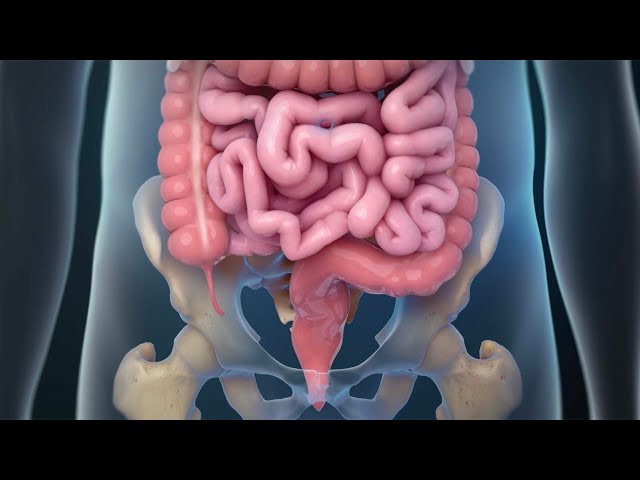 Colorectal Cancer Surgery: Rectum Removal