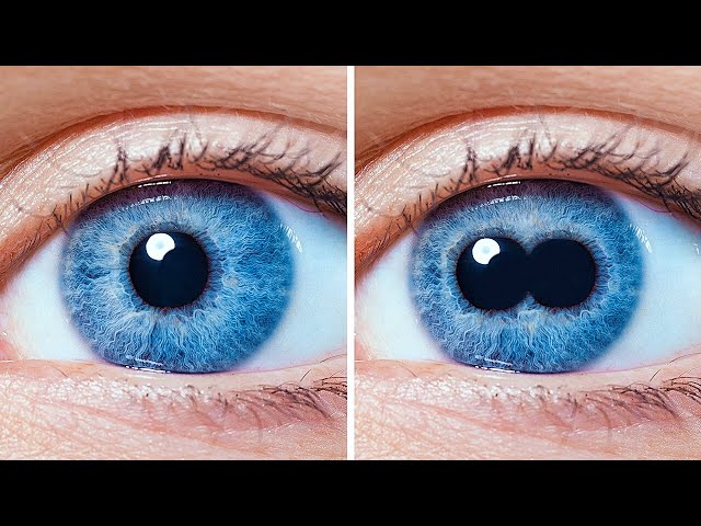 Zwei Pupillen in einem Auge Und andere seltsame Körperkuriositäten