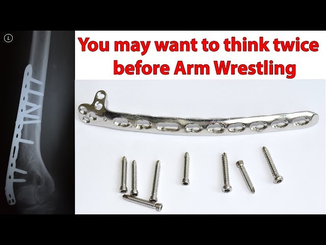 Part 2. How I broke my Humerus during Arm Wrestling. Removal of the Plate and Screws