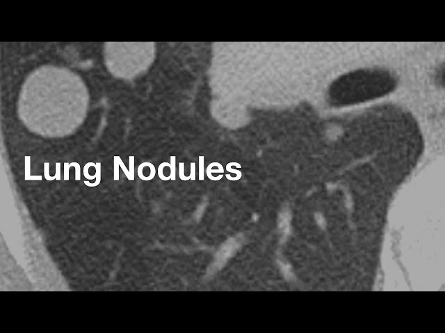 Lung Nodules (basics for patients)