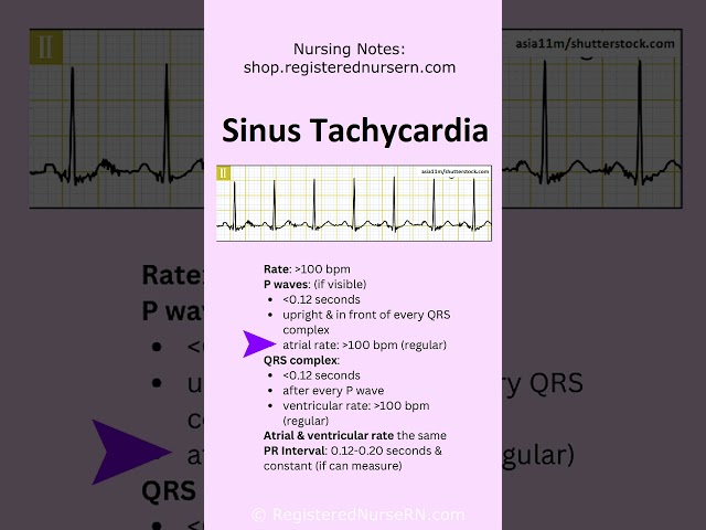 Sinus Tachycardia EKG ECG Rhythm Nursing Review in 60 Seconds #shorts #ecg #nursing