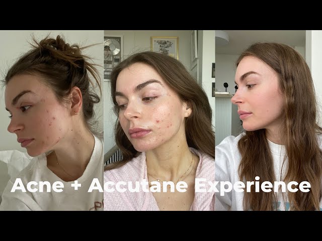 ACNE & EPURIS (ACCUTANE) EXPERIENCE | journey & side effects