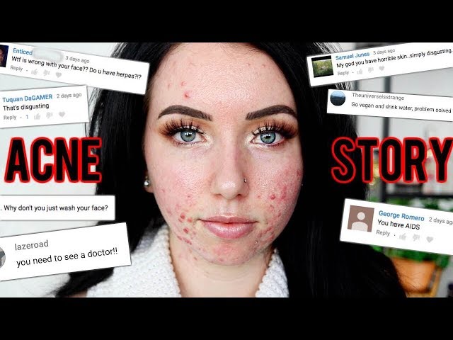 MY ACNE STORY & Going on Accutane