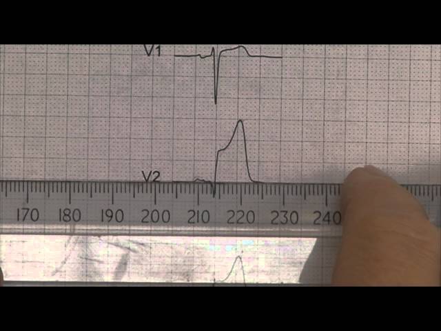 Heart disease 12, Clinical 12 lead STEMI ECG (EKG)