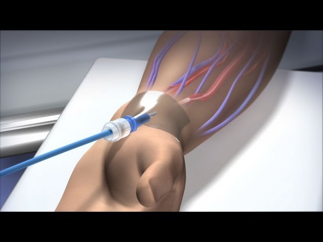 New Route to the Heart - Mayo Clinic
