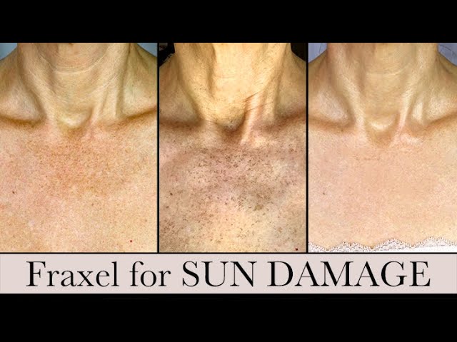 Fraxel Laser for Sun Damage | 2nd Treatment Results!