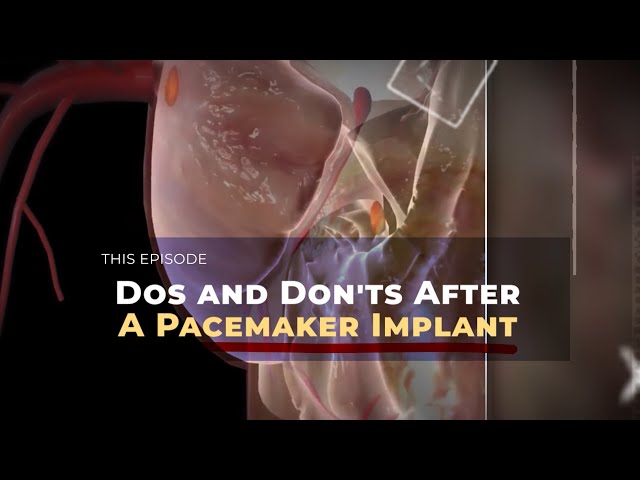 Dos and Don'ts After A Pacemaker Implant