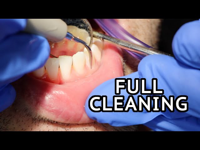 How Teeth Are Cleaned At The Dentist