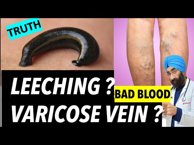 Can Leeching detox body & Cure Varicose veins | hirudotherapy | Dr.Education