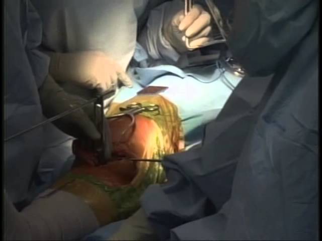 Watch a knee replacement surgery at St. Luke's Hospital