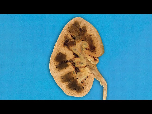 A Boy Put On A Pair Of Suspicious Socks. This Is What Happened To His Kidneys.