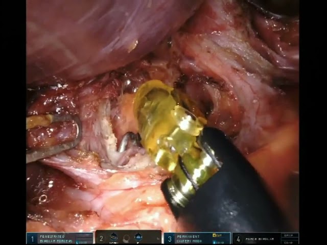 Robot Assisted Laparoscopic Median Arcuate Ligament Release