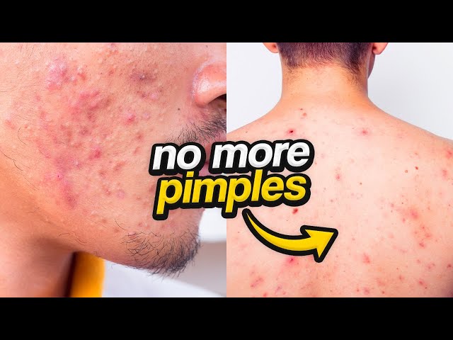 This is WHY You're Getting Pimples | Men's Skincare Tips