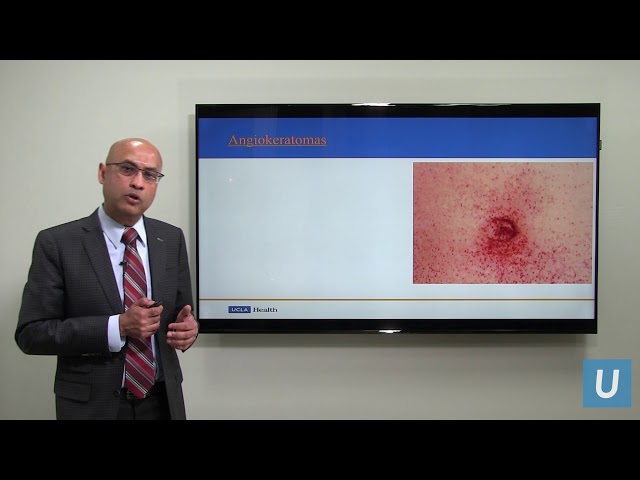 Fabry's Disease: What You Should Know | Anjay Rastogi, MD, PhD | UCLAMDChat