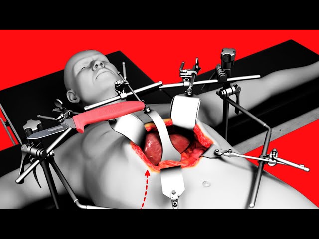 Valve Replacement Surgery ( 3D Animation ) | Open Procedure