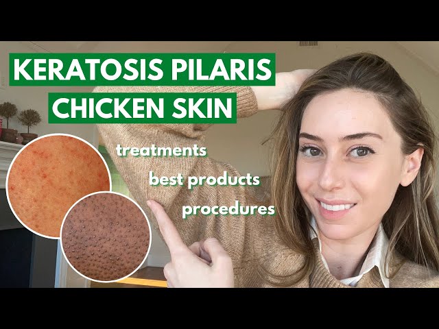 Keratosis Pilaris: How to treat dry bumpy skin aka chicken skin! | Dr. Shereene Idriss