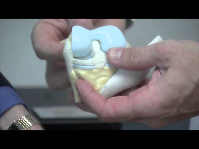 Penn Joint Replacement Service -- Overview by Dr. Craig Israelite